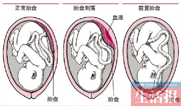 胎盘低几个月最危险，深度解析与应对策略